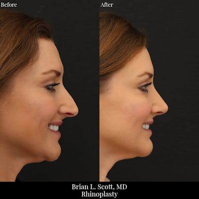 Rhinoplasty Before & After Gallery - Patient 175874 - Image 1