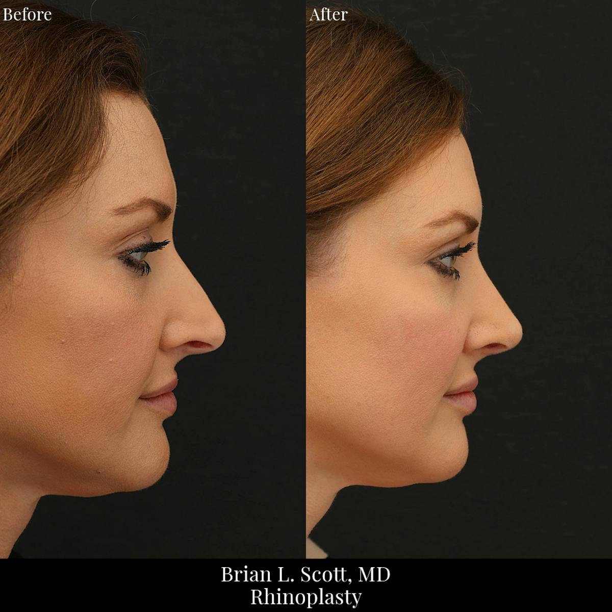 Rhinoplasty Before & After Gallery - Patient 175874 - Image 2