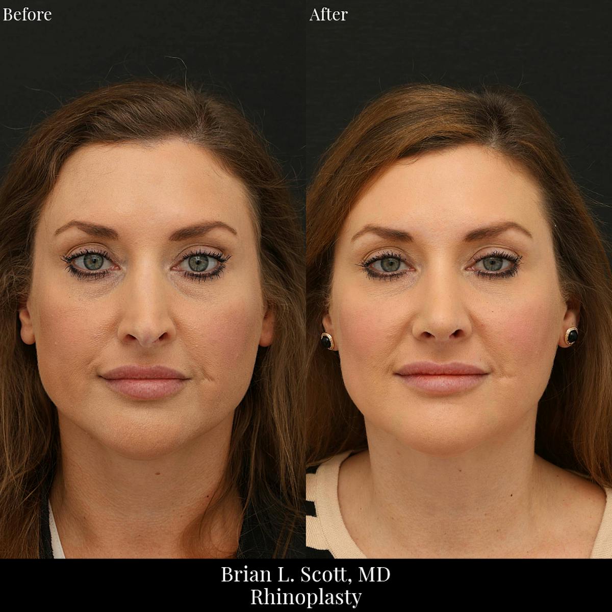 Rhinoplasty Before & After Gallery - Patient 175874 - Image 4