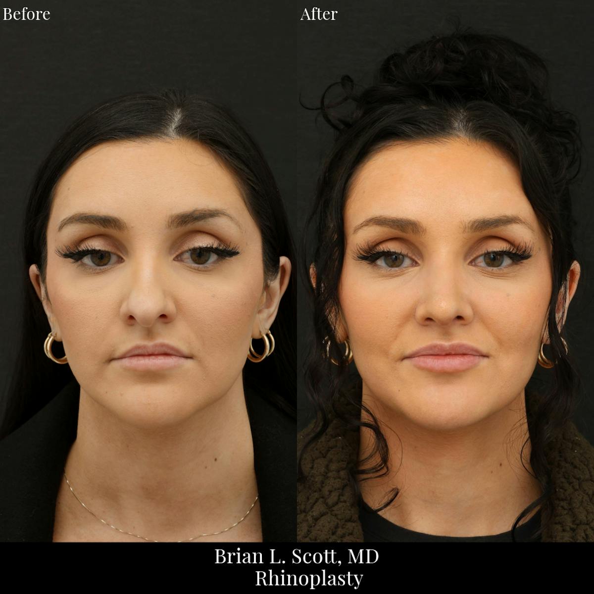 Rhinoplasty Before & After Gallery - Patient 321407 - Image 3