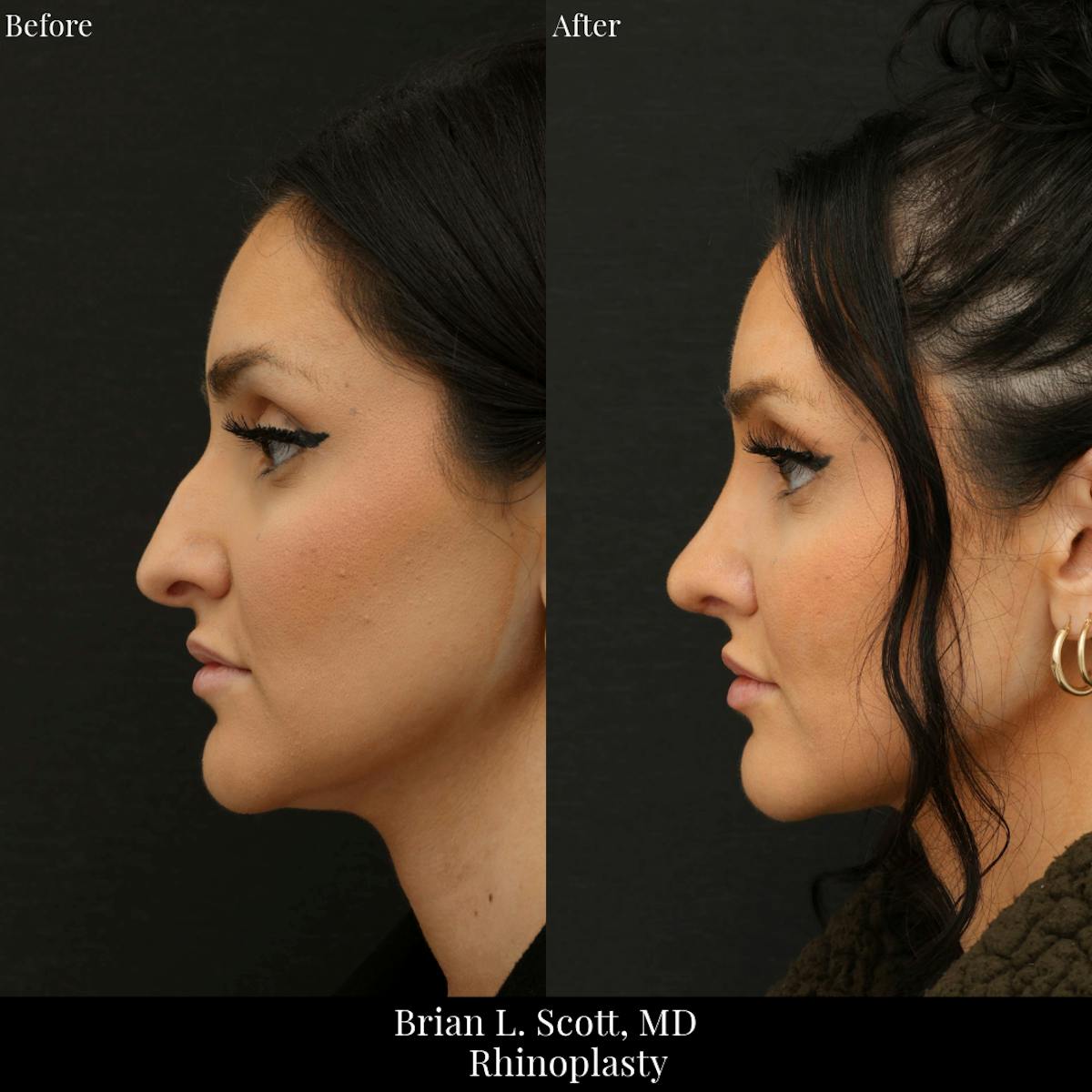 Rhinoplasty Before & After Gallery - Patient 321407 - Image 2