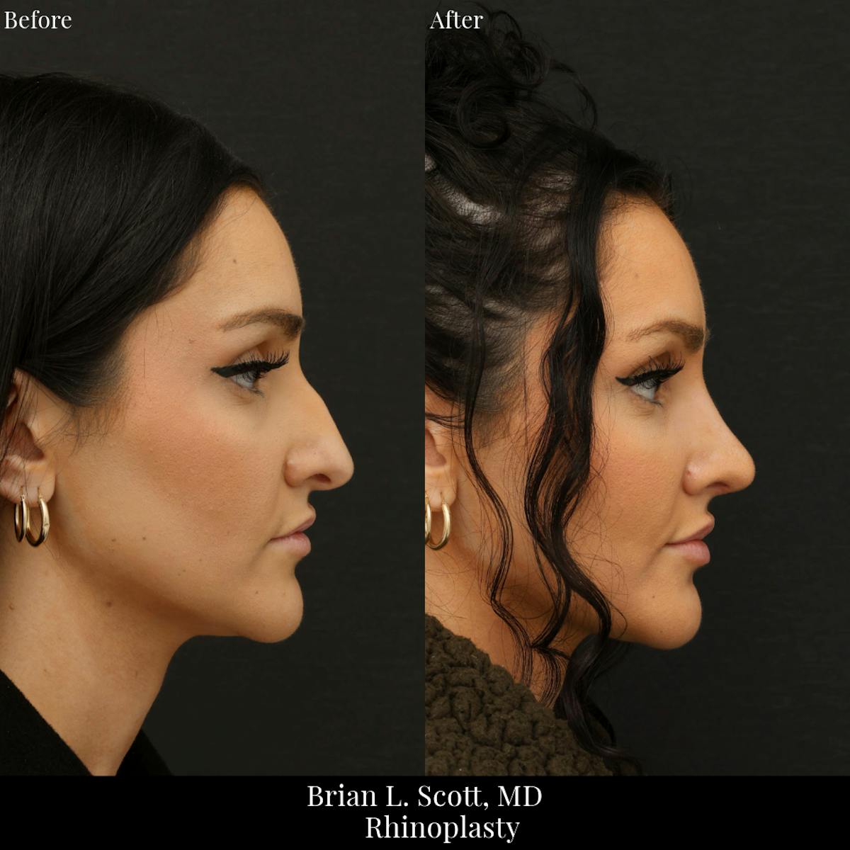Rhinoplasty Before & After Gallery - Patient 321407 - Image 1