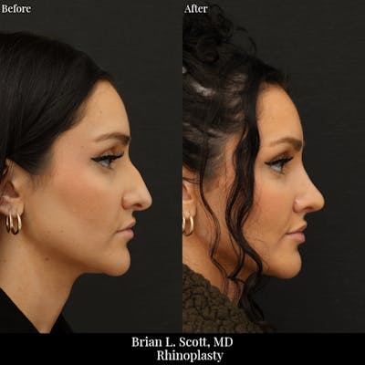 Rhinoplasty Before & After Gallery - Patient 321407 - Image 1