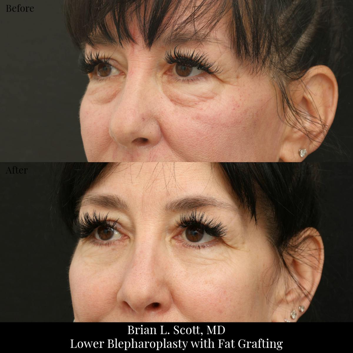 Facial Fat Transfer Before & After Gallery - Patient 105500 - Image 4