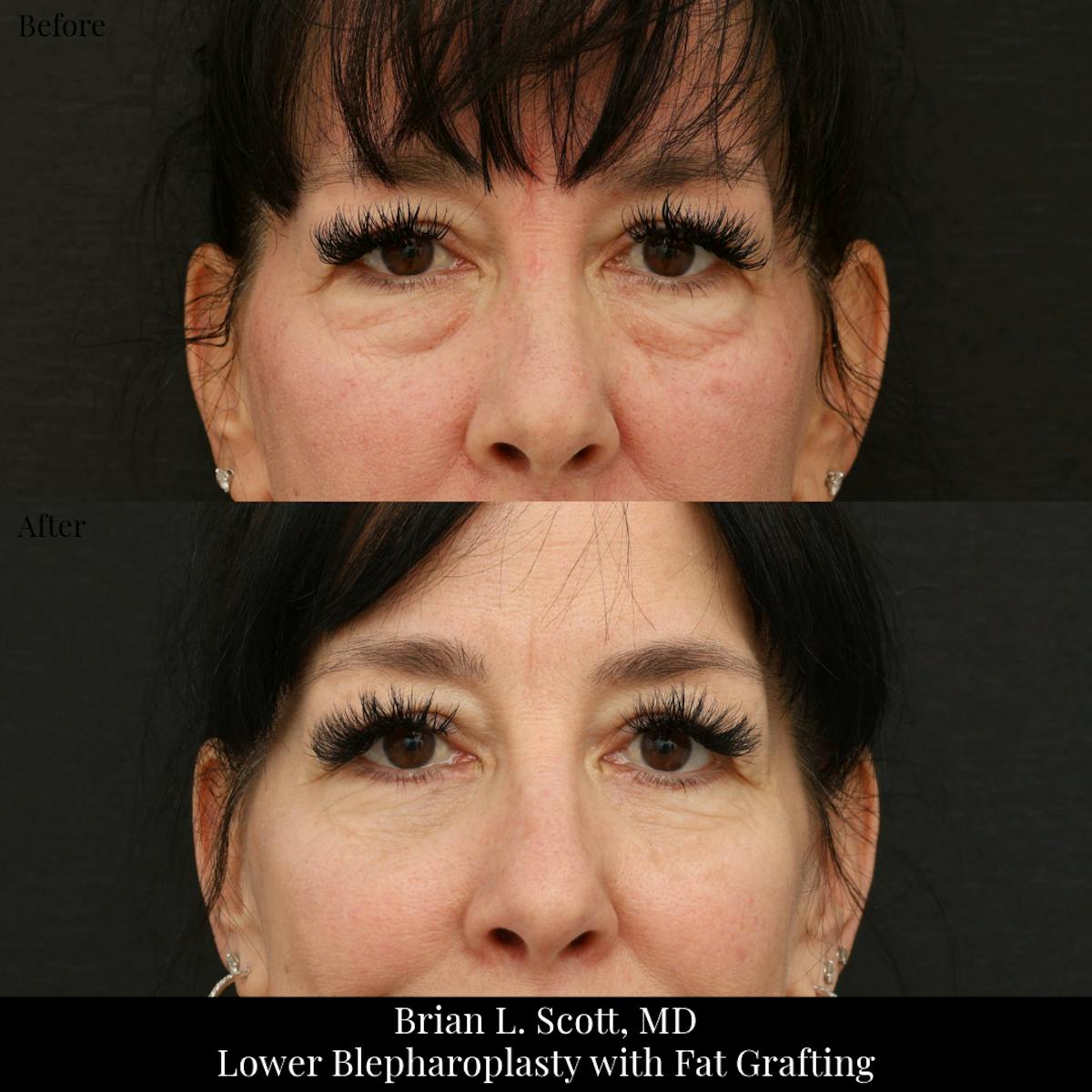 Facial Fat Transfer Before & After Gallery - Patient 105500 - Image 3