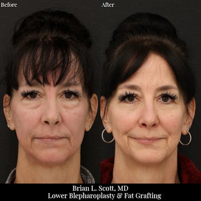 Facial Fat Transfer Before & After Gallery - Patient 105500 - Image 1