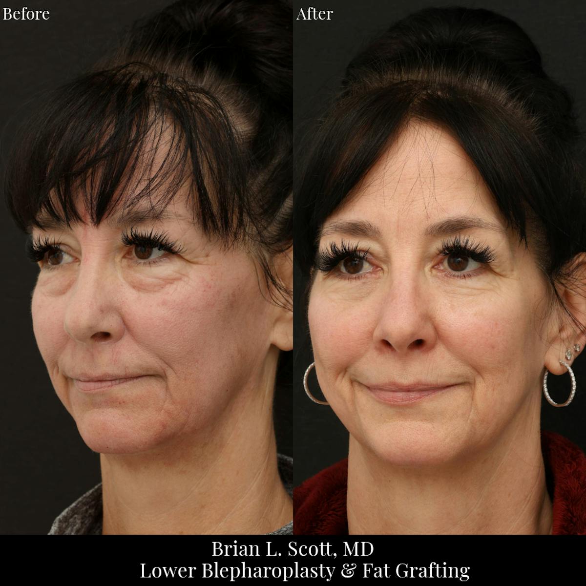Facial Fat Transfer Before & After Gallery - Patient 105500 - Image 2