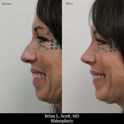 Rhinoplasty Before & After Gallery - Patient 761719 - Image 1