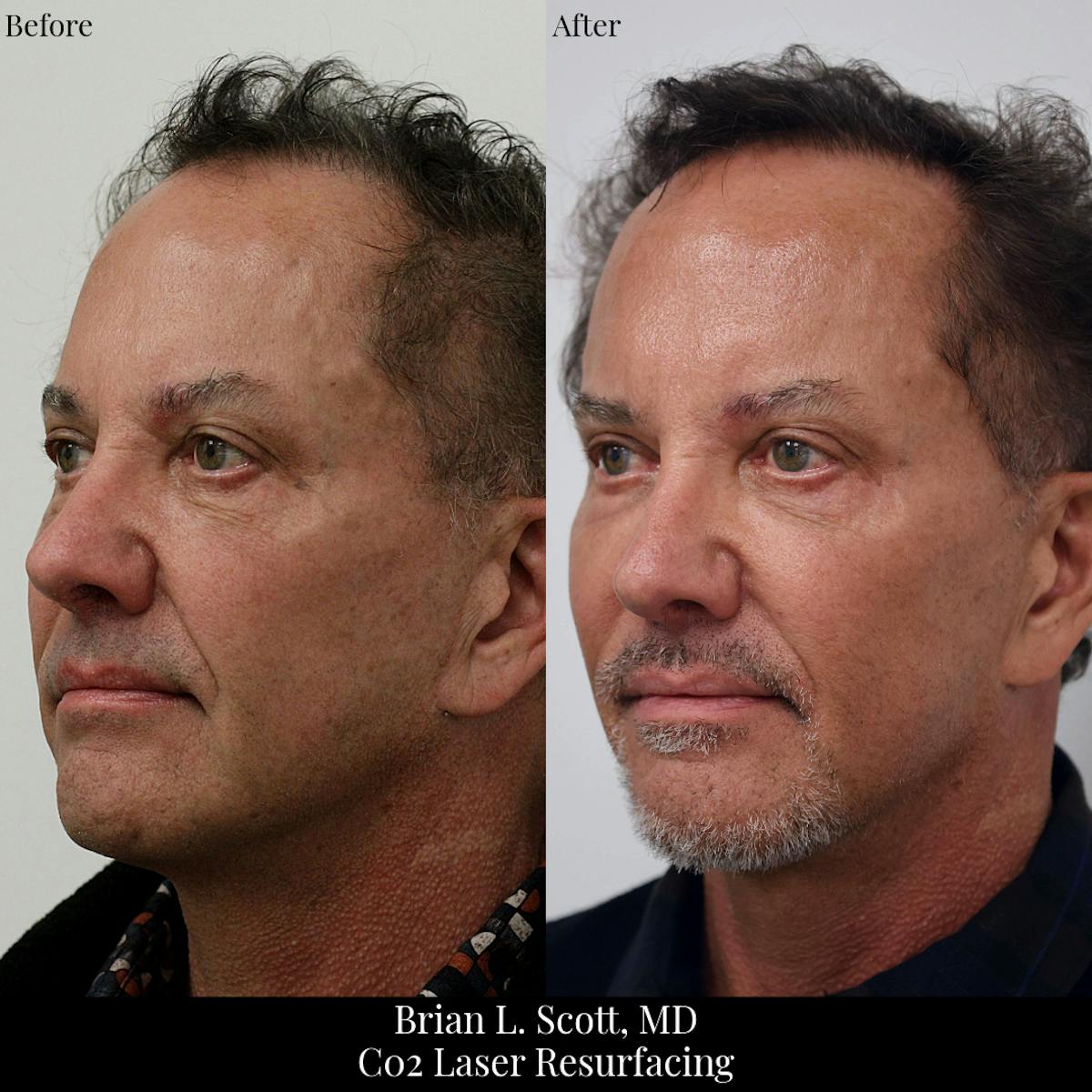 Laser Resurfacing Before & After Gallery - Patient 293664 - Image 2
