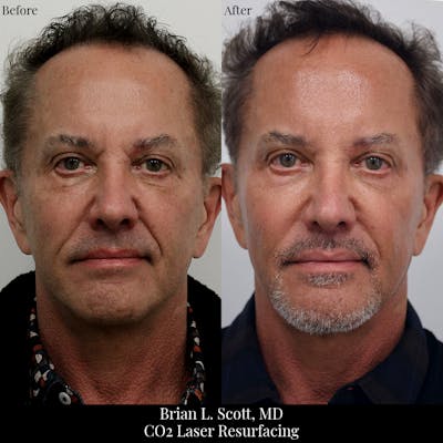 Laser Resurfacing Before & After Gallery - Patient 293664 - Image 1