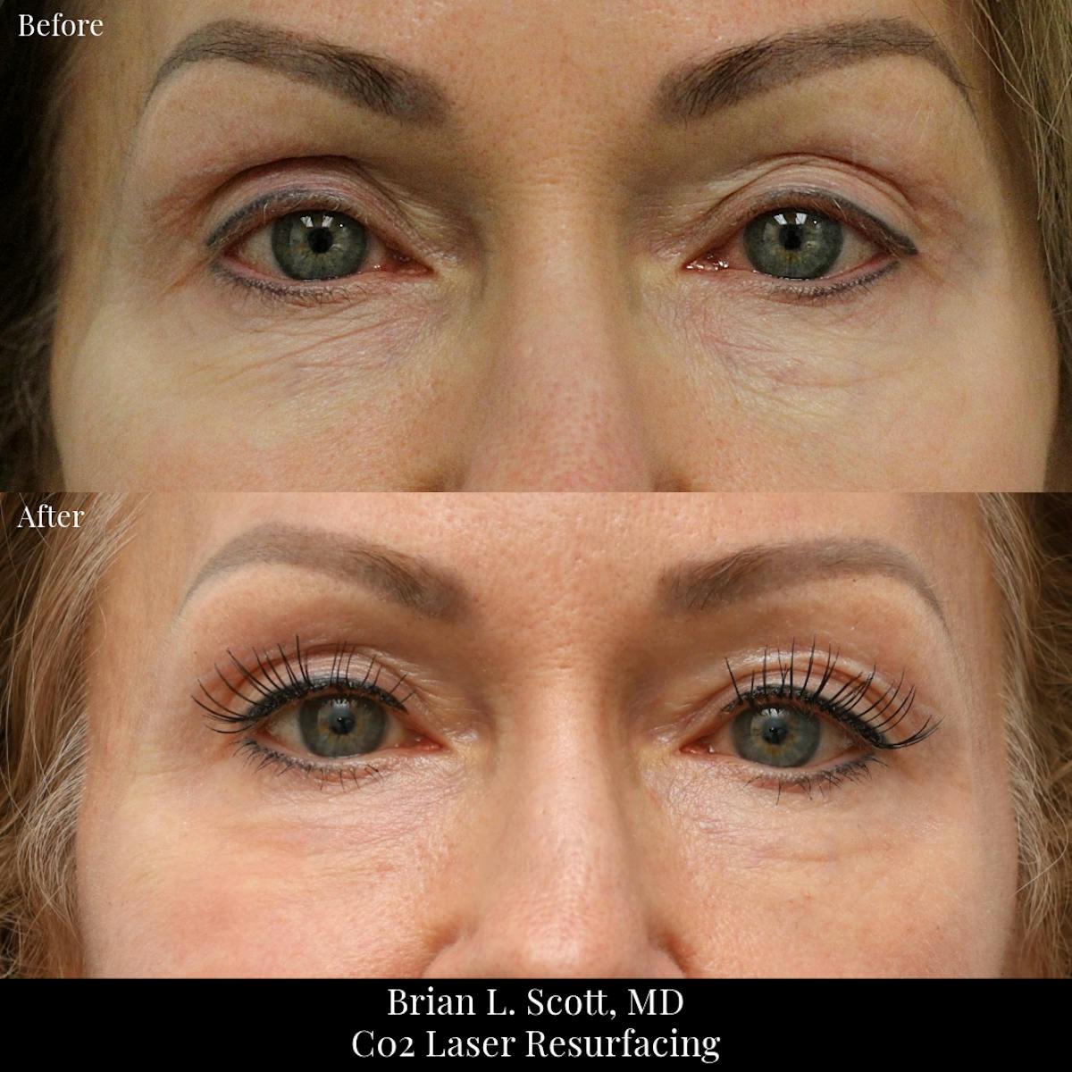 Lasers Before & After Gallery - Patient 386036 - Image 1