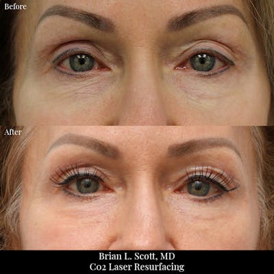 Laser Resurfacing Before & After Gallery - Patient 207964 - Image 1