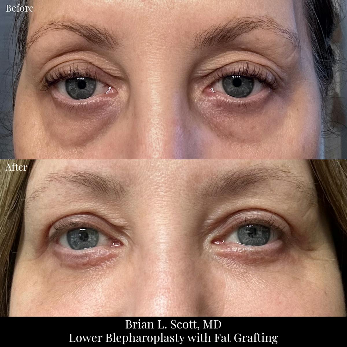Facial Fat Transfer Before & After Gallery - Patient 138331 - Image 1