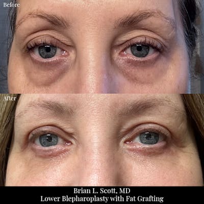 Lower Blepharoplasty Before & After Gallery - Patient 173211 - Image 1