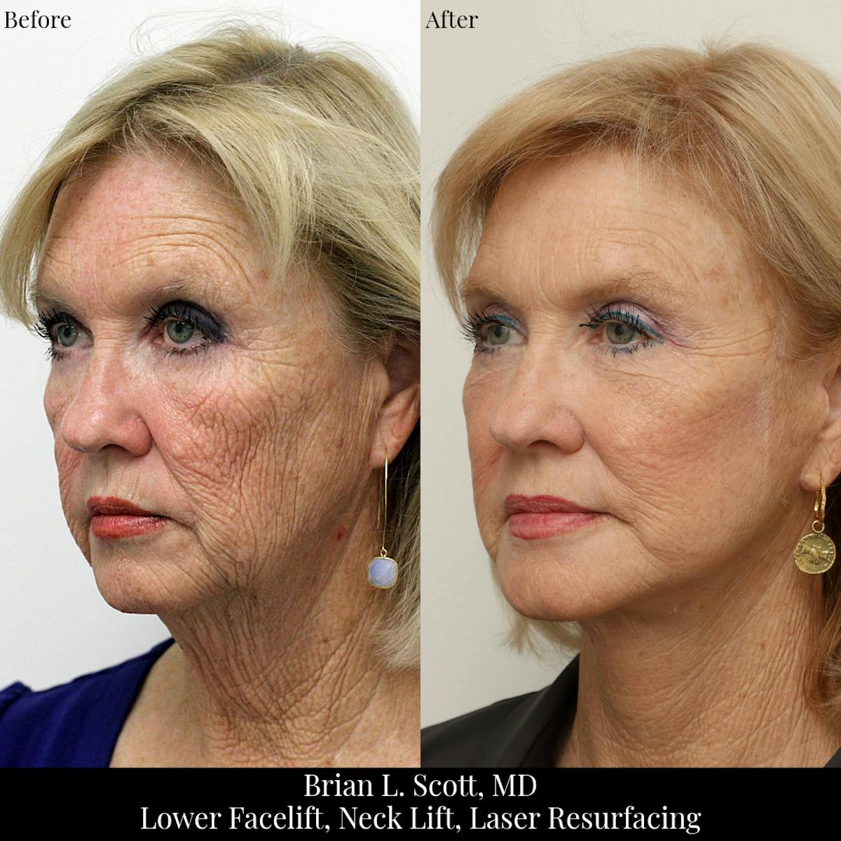 Neck Lift Before & After Gallery - Patient 360602 - Image 2