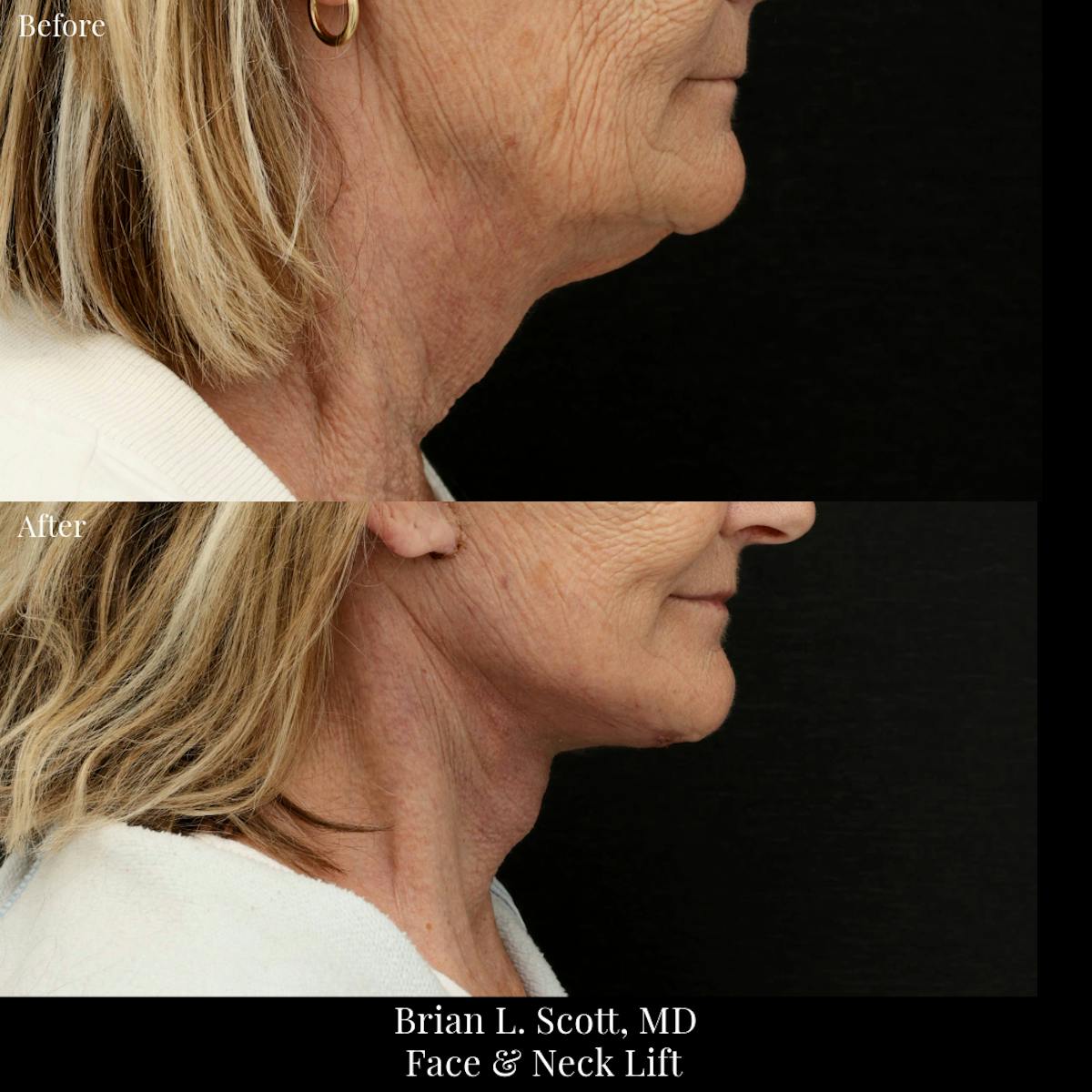 Neck Lift Before & After Gallery - Patient 382075 - Image 1