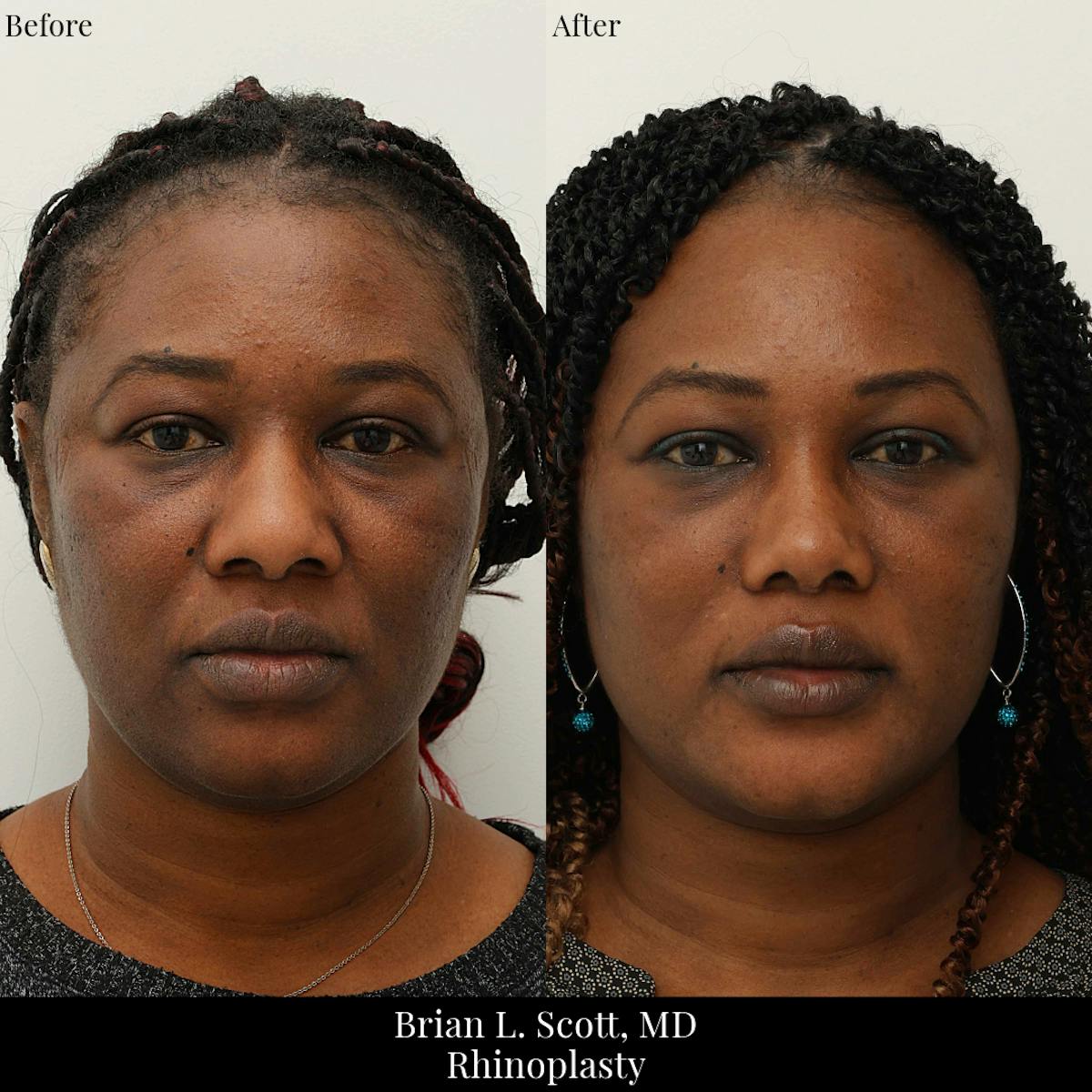 Rhinoplasty Before & After Gallery - Patient 368726 - Image 3