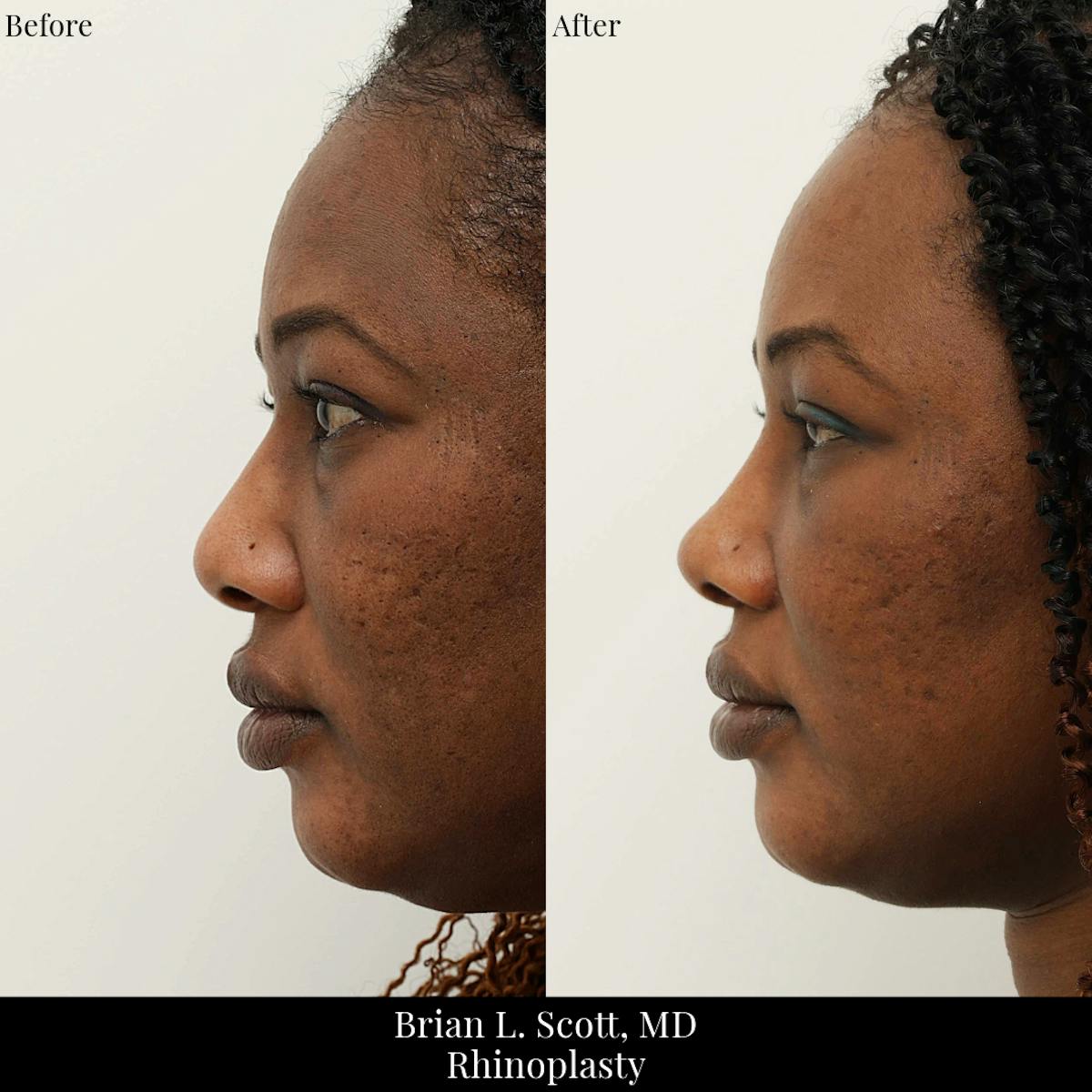 Rhinoplasty Before & After Gallery - Patient 368726 - Image 2