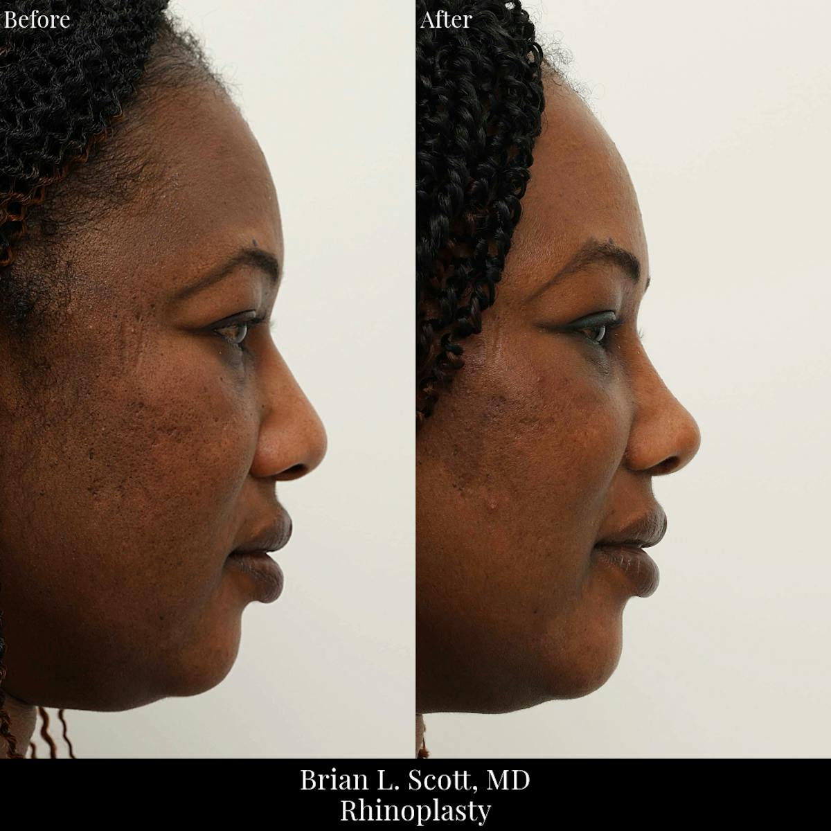Rhinoplasty Before & After Gallery - Patient 368726 - Image 1