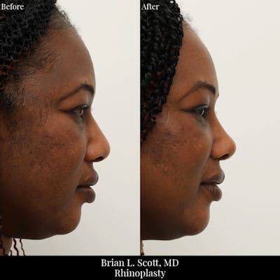Rhinoplasty Before & After Gallery - Patient 368726 - Image 1