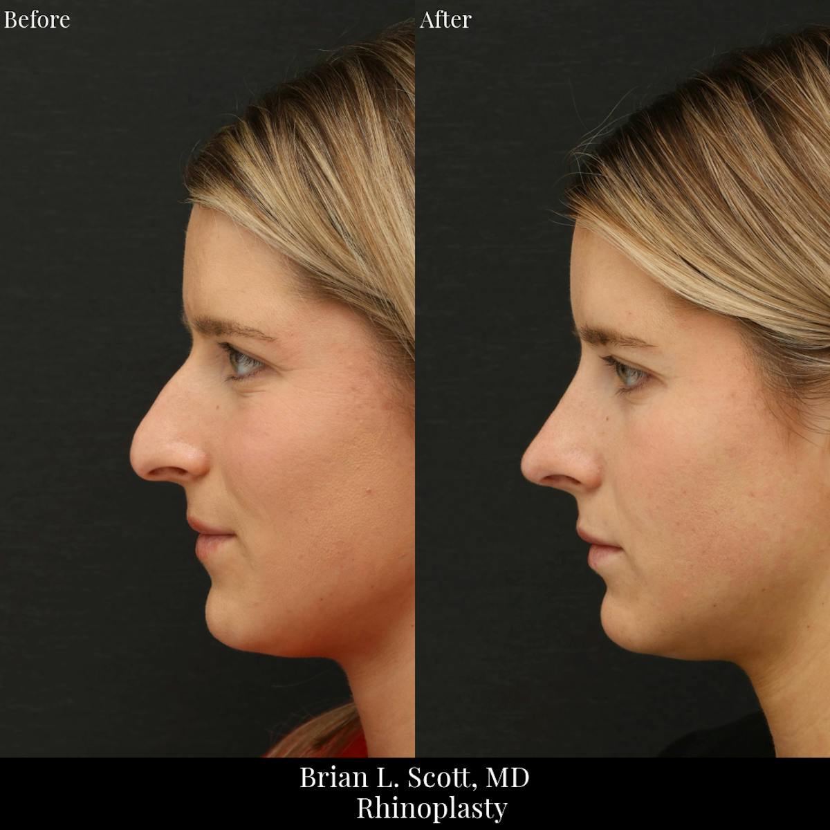 Rhinoplasty Before & After Gallery - Patient 221182 - Image 1
