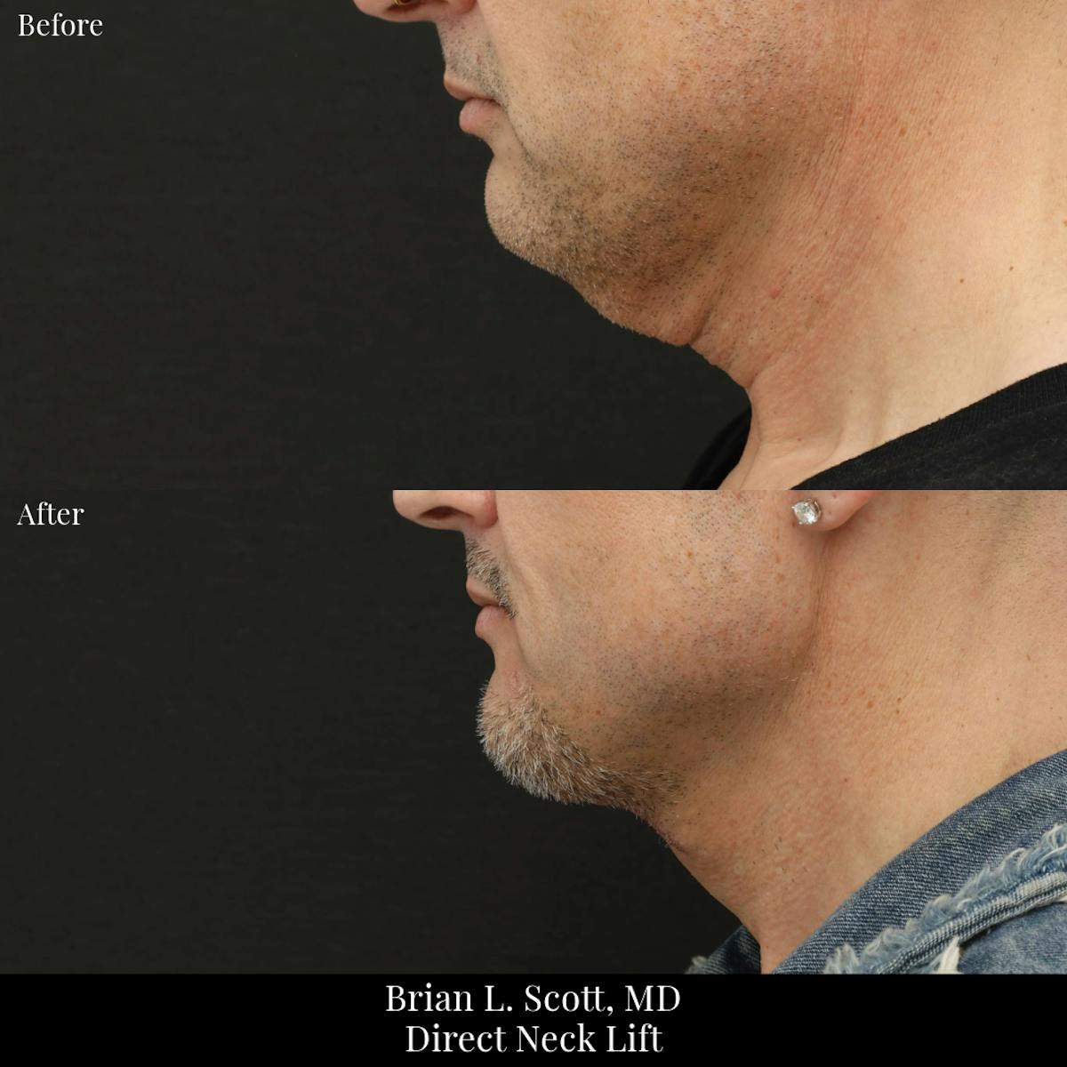 Neck Lift Before & After Gallery - Patient 759200 - Image 1