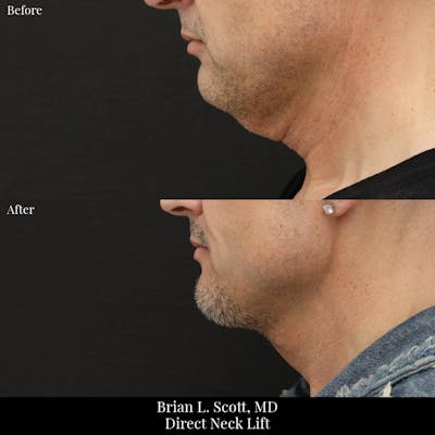 Neck Lift Before & After Gallery - Patient 759200 - Image 1