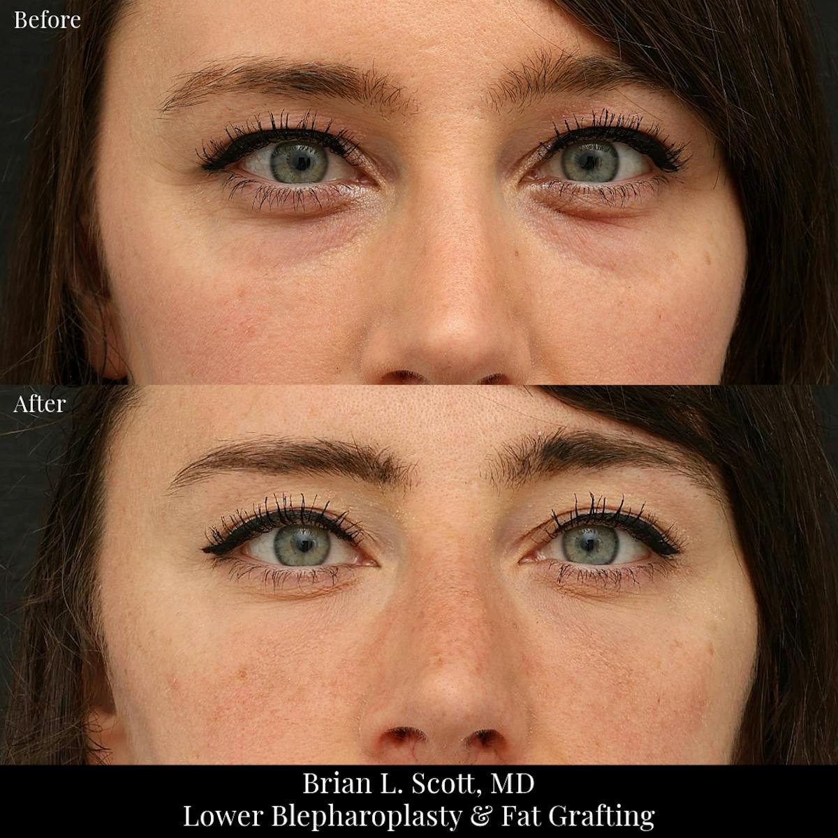Lower Blepharoplasty Before & After Gallery - Patient 345337 - Image 1
