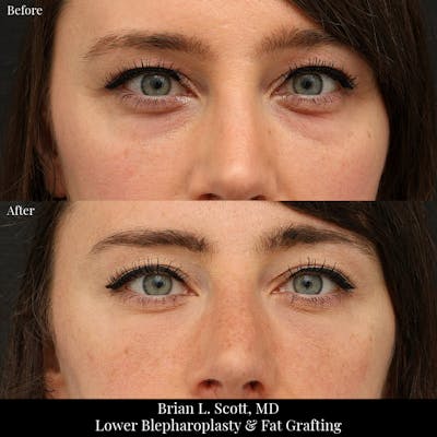 Lower Blepharoplasty Before & After Gallery - Patient 345337 - Image 1