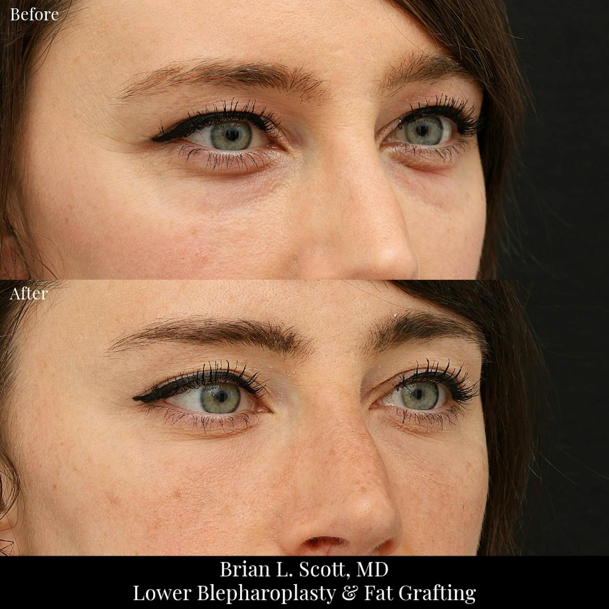 Lower Blepharoplasty Before & After Gallery - Patient 345337 - Image 2