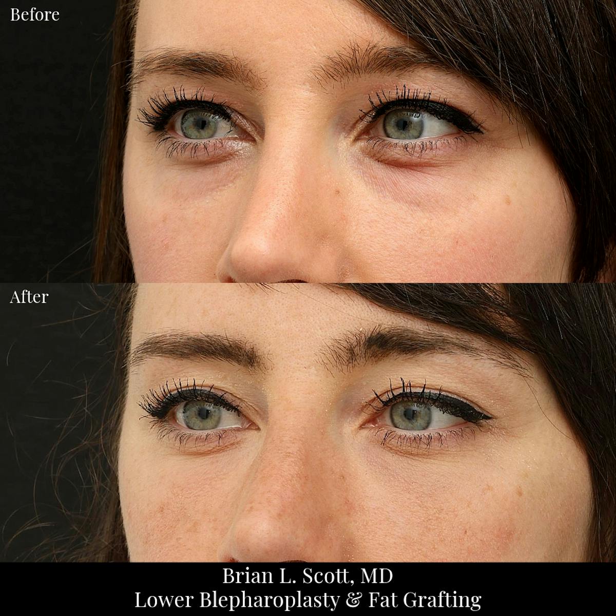 Lower Blepharoplasty Before & After Gallery - Patient 345337 - Image 3