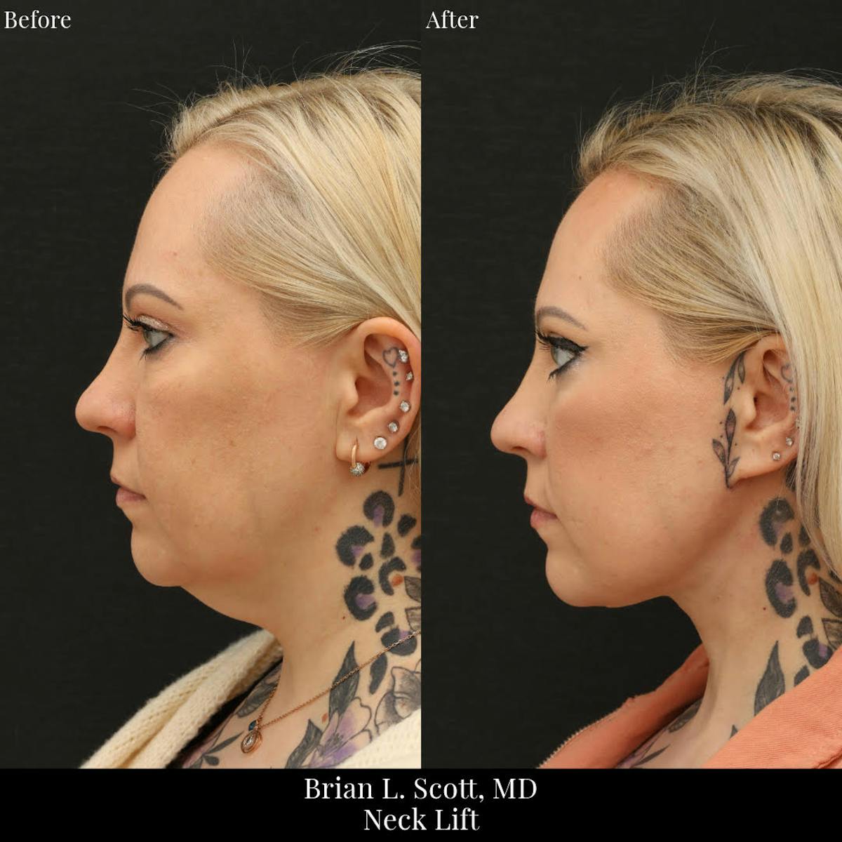 Neck Lift Before & After Gallery - Patient 168394 - Image 2