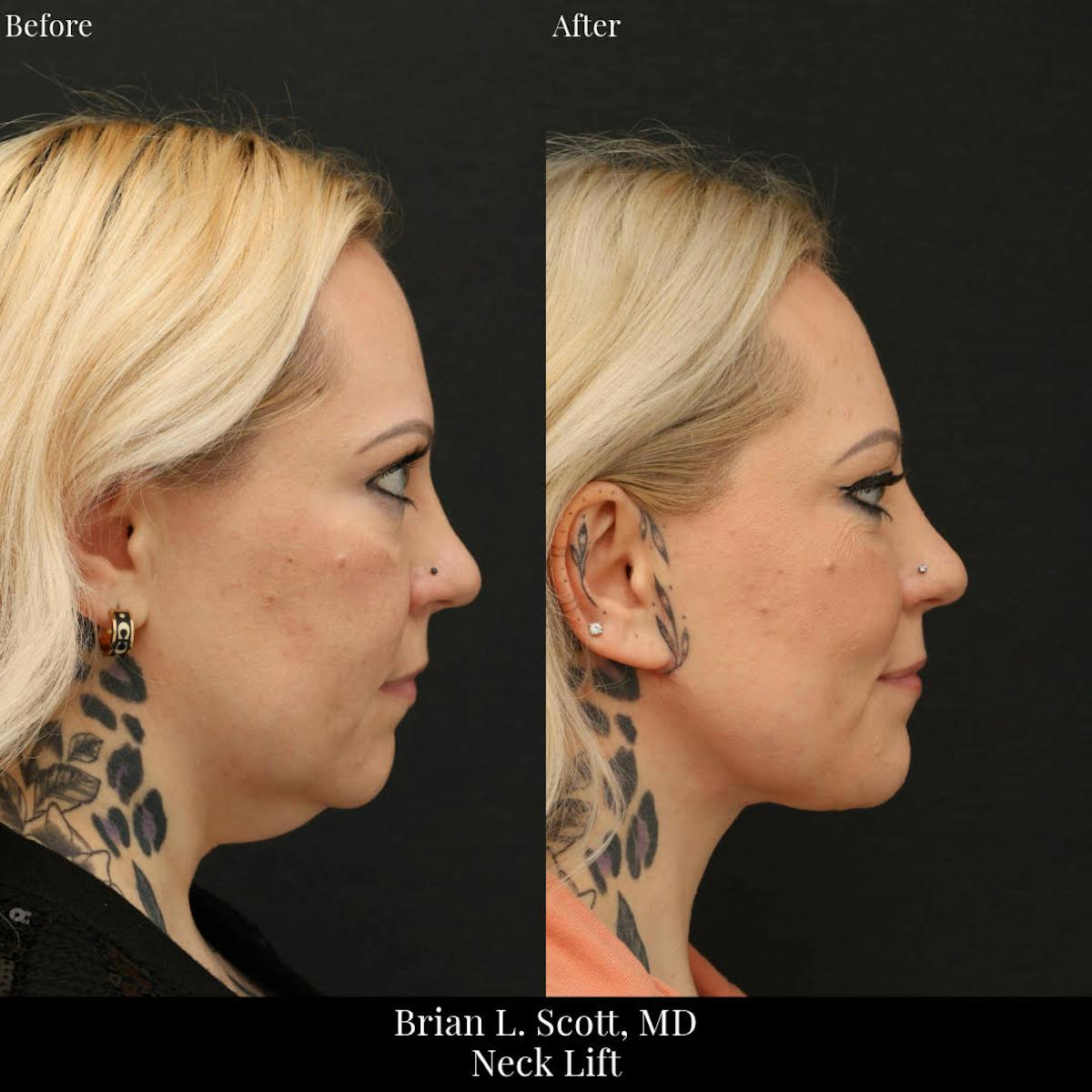 Neck Lift Before & After Gallery - Patient 168394 - Image 1