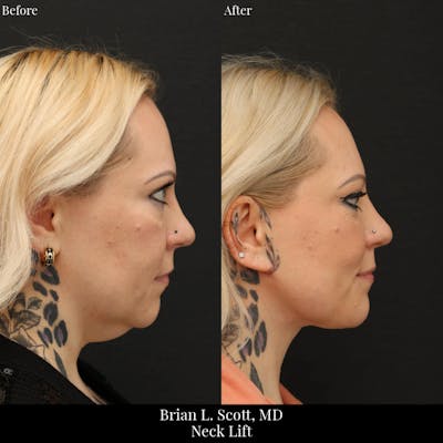 Neck Lift Before & After Gallery - Patient 168394 - Image 1
