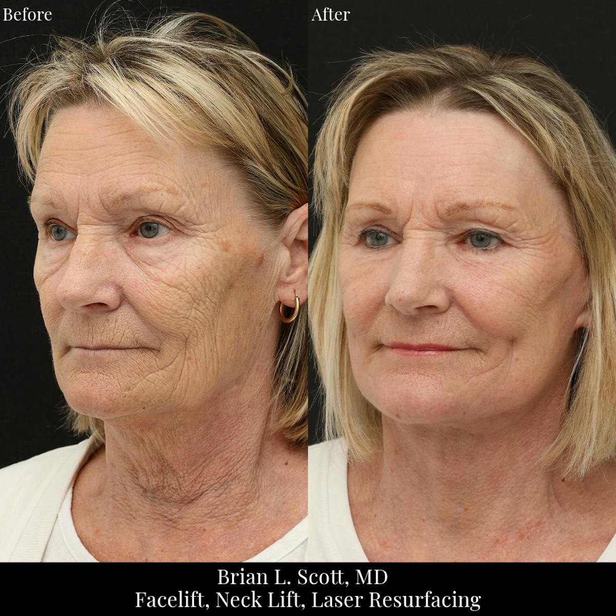 Facelift Before & After Gallery - Patient 419472 - Image 3