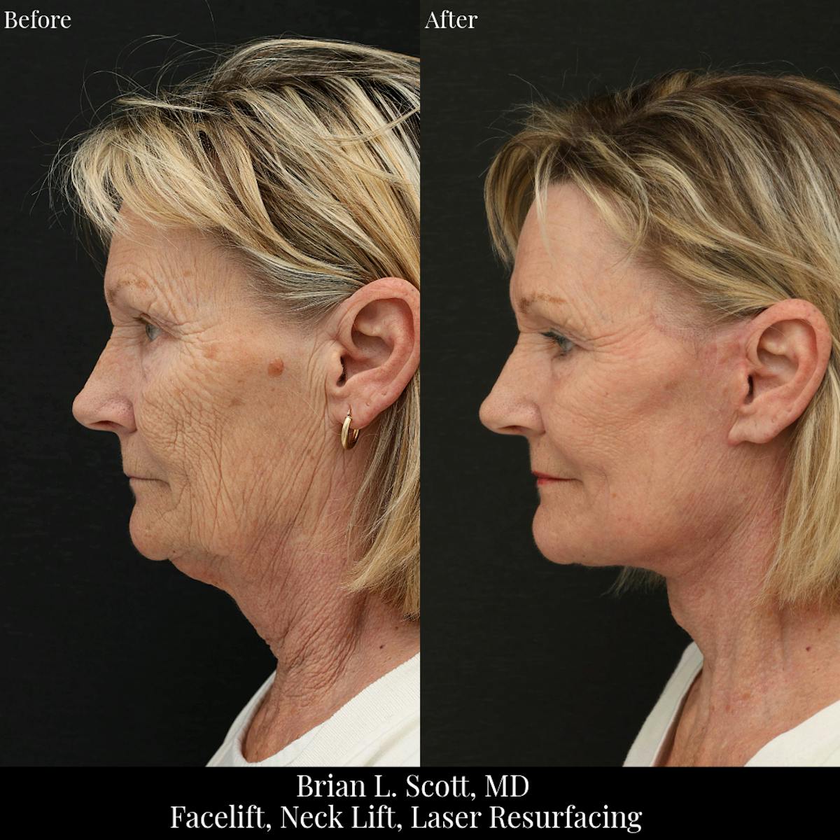 Facelift Before & After Gallery - Patient 419472 - Image 1