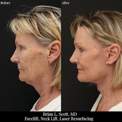 Laser Resurfacing Before & After Gallery - Patient 392558 - Image 1