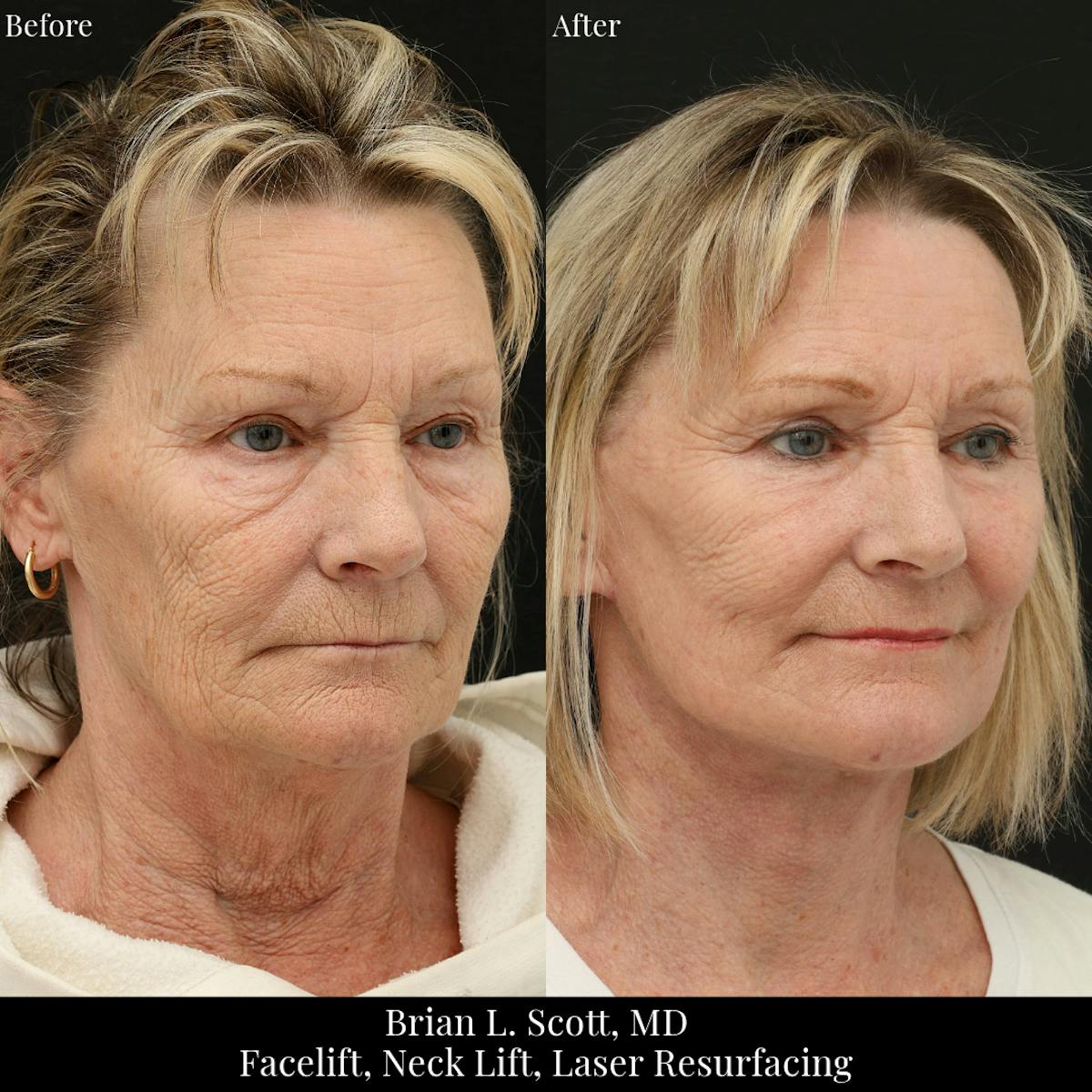 Facelift Before & After Gallery - Patient 419472 - Image 2