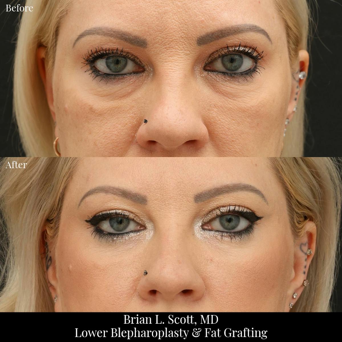 Lower Blepharoplasty Before & After Gallery - Patient 276162 - Image 1