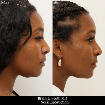 Neck Liposuction Before & After Gallery - Patient 305287 - Image 1