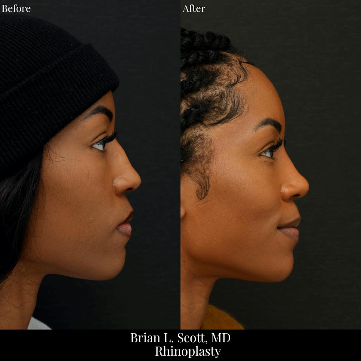 Rhinoplasty Before & After Gallery - Patient 324304 - Image 1