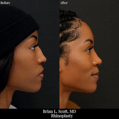 Rhinoplasty Before & After Gallery - Patient 324304 - Image 1