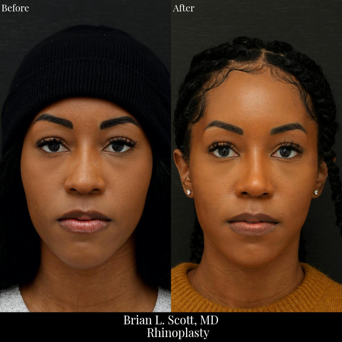 Rhinoplasty Before & After Gallery - Patient 324304 - Image 3