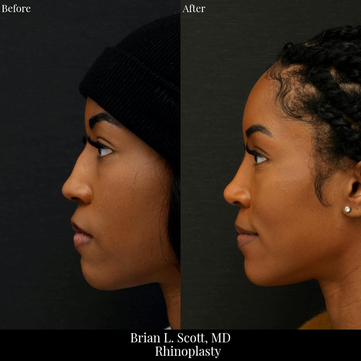 Rhinoplasty Before & After Gallery - Patient 324304 - Image 2