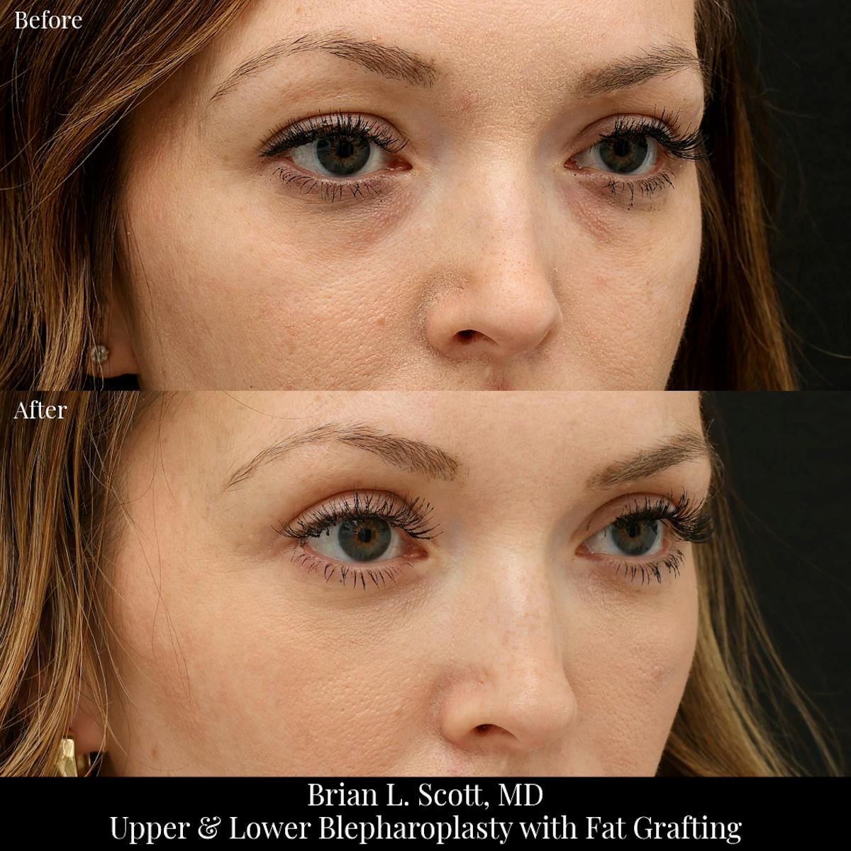 Upper Blepharoplasty Before & After Gallery - Patient 272530 - Image 2