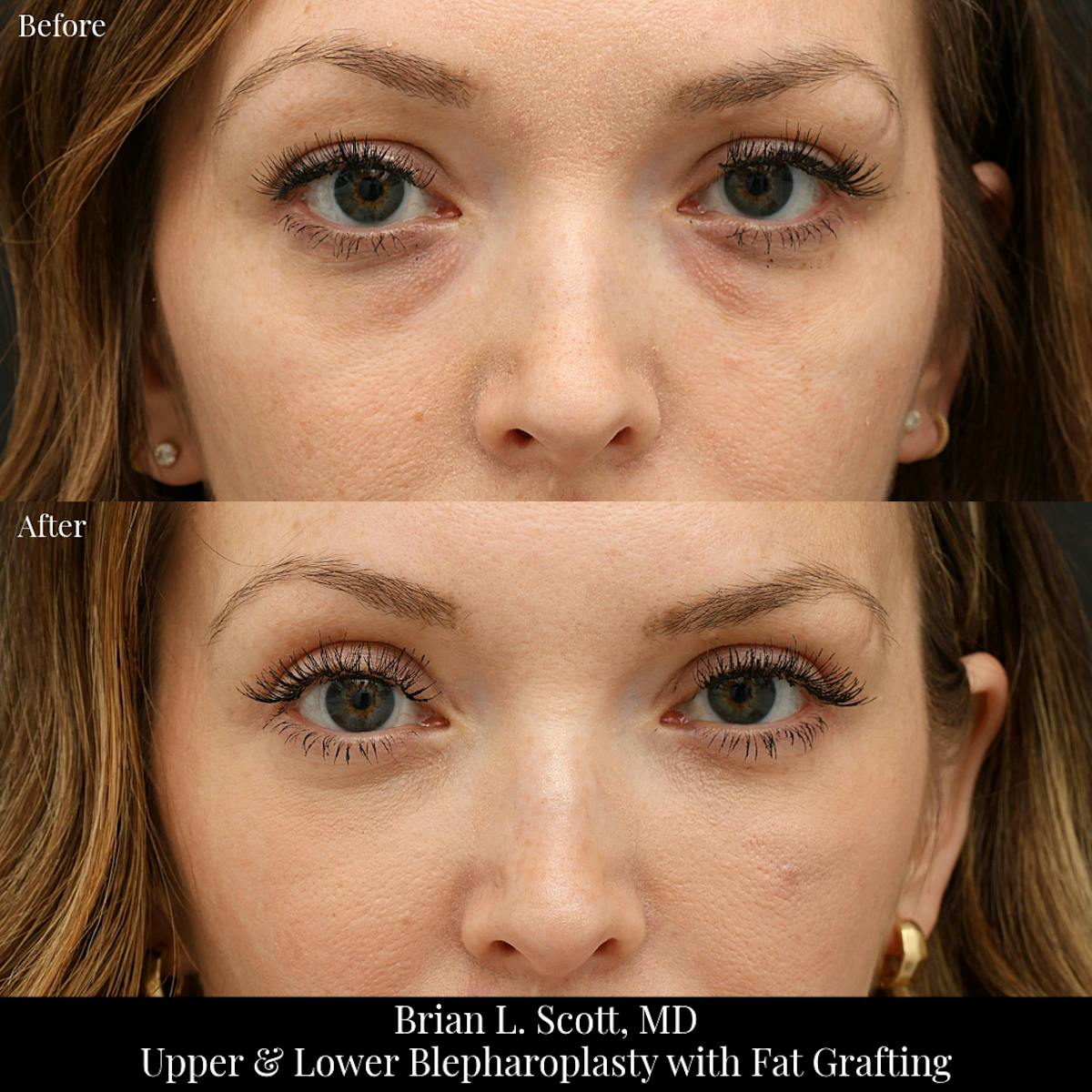 Upper Blepharoplasty Before & After Gallery - Patient 272530 - Image 1