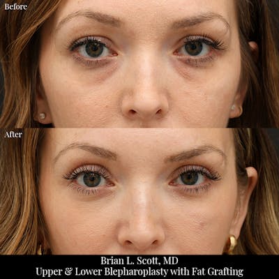 Upper Blepharoplasty Before & After Gallery - Patient 272530 - Image 1