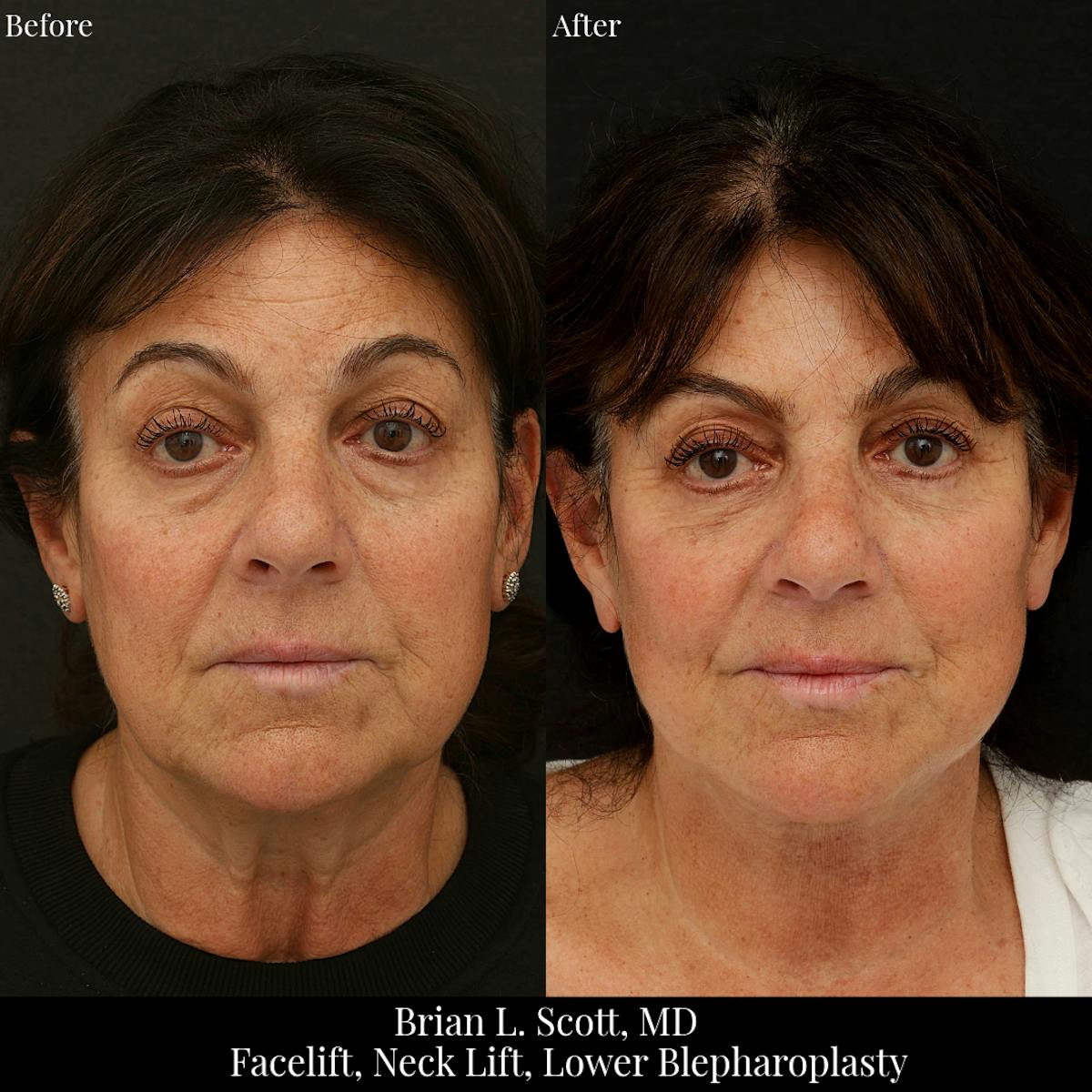 Neck Lift Before & After Gallery - Patient 353249 - Image 4