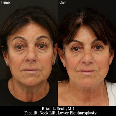 Lower Blepharoplasty Before & After Gallery - Patient 282417 - Image 1