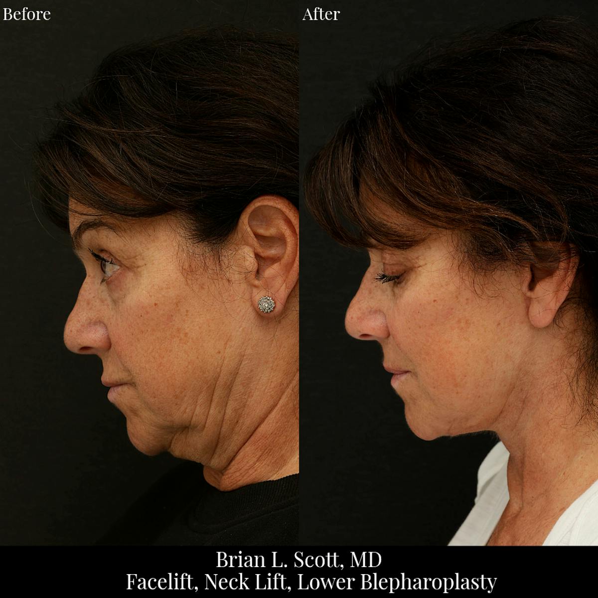 Neck Lift Before & After Gallery - Patient 353249 - Image 1